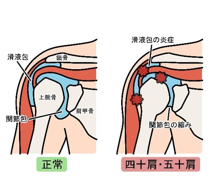 つらい肩の痛みの原因は？肩の痛みの2大原因「四十肩・五十肩と腱板損傷」を簡単解説