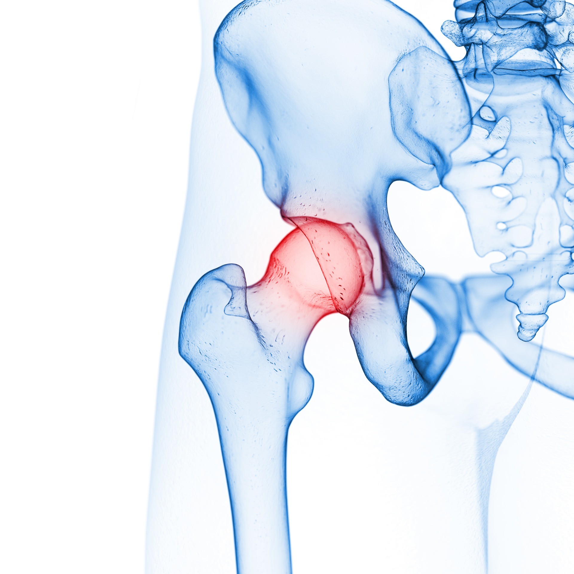 大腿骨頭壊死症とは